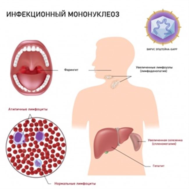 Причины мононуклеоза